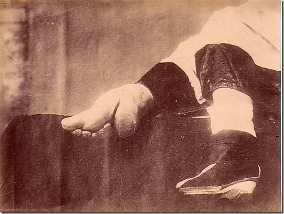 Старинные туфли для деформированных ног